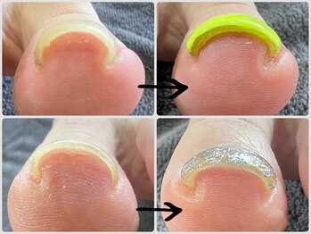 巻き爪/フットネイル/ワンカラー