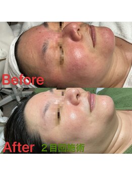 ラウナ(LAUNA)/剥離なしハーブピーリング