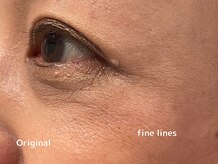 オアシスラグーン(OASIS LAGOON)/しわケア（症例３：before）