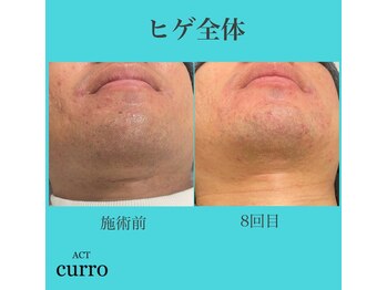 アクト クロ(ACT curro)/【ヒゲ全体】脱毛施術例