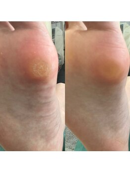 上高田つつじ整体院/タコのケア　施術例