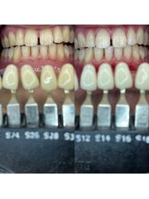 トウキョースワーズ 渋谷店(TOKYO SWRS)/#ホワイトニング #渋谷 #池袋