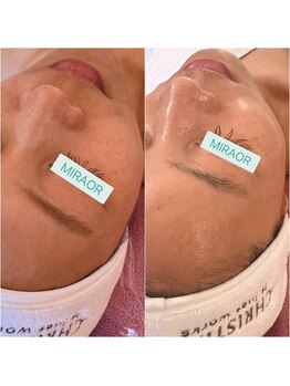 ミラー(MIRAOR)/アンストレスBefore/ After