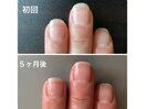 折れやすい・爪周りの荒れが悩み