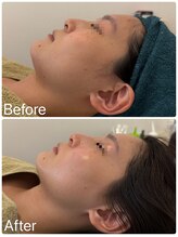 サロンドフェイス(Salon de Faith)/コルギ+エニシーグローパック2回