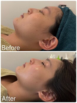 サロンドフェイス(Salon de Faith)/コルギ+エニシーグローパック2回