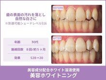 クレア(Crea)/【歯のホワイトニング症例写真】