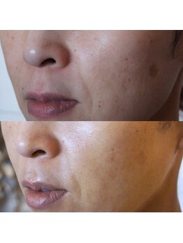 トラット エステアンドアイズ(tratto)/30代　お客様症例写真