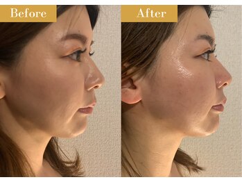 モモスパ(MOMOspa.)/頭蓋骨小顔矯正ビフォアフター