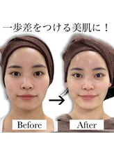 リノア(Linoa)/北陸で施術できるのは当店のみ！