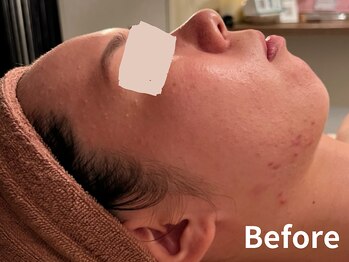 ダイヤモンド リーエンダ(Diamond leende)/クレイハーブピーリング