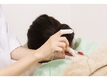 御茶の水ドライN鍼灸/微弱電流を用いた電気鍼