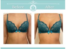 美人バスト 本厚木店/バストアップ◇症例◇