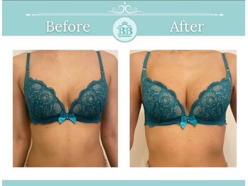 美人バスト 本厚木店/バストアップ◇症例◇