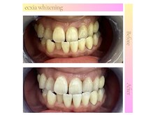 エクシアホワイトニング 新白河店/ホワイトニングビフォーアフター