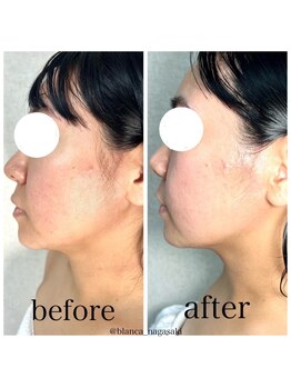 ブランカ ナガサキ(BLANCA NAGASAKI)/インディバ1回＋エクソソーム3cc