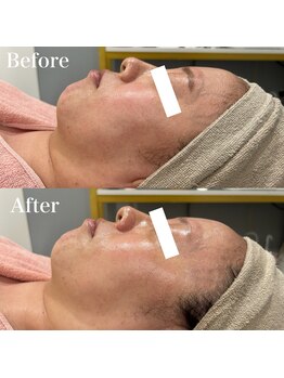 ジョアアンジェ 京橋店(joie ange)/ララピール1回