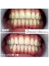 ホワイトニングサロン 京都烏丸店/ホワイトニング施術例