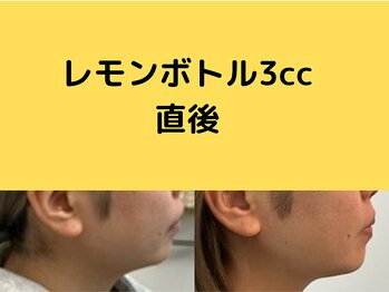 フェリス(feliz)/レモンボトル[小顔/美白/白石区]