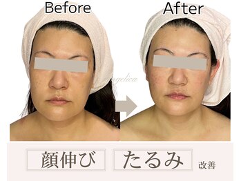 アンジェリカ(Angelica)/顔の長さ/二重アゴ/小顔/顔伸び