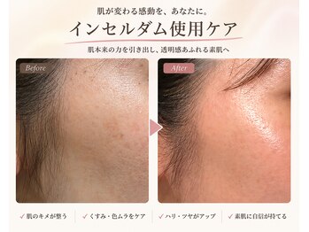 ベリル(BERYL)/インセルダムケアで水光肌に!