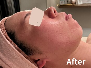 ダイヤモンド リーエンダ(Diamond leende)/クレイハーブピーリング