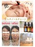 【毛穴/しわたるみでお悩みの方へ！】艶肌純粋レチノールチャージTR ¥22000