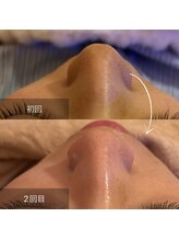 ウナ サロン ド グッドスタイル(UNA SALON DE GOOD STYLE)/毛穴ブラックフェイシャル