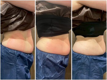 ビュウナ 銀座(BEAUNA)/脂肪冷却/frozen8