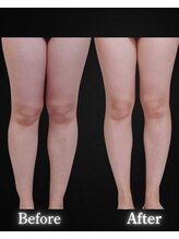 サンティエ(Santie)/脚ケアにはコレ