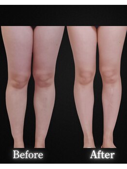 サンティエ(Santie)/脚ケアにはコレ