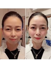 ルピナス(Lupinus)/大人気の炭酸ガスパック！