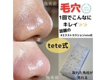 サロン リュンヌ(salon lune)/毛穴エクストラクション