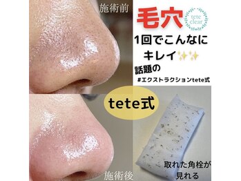 サロン リュンヌ(salon lune)/毛穴エクストラクション