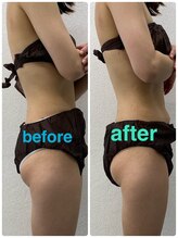 ハロ 南青山(HALO)/全身ラジオ波痩身