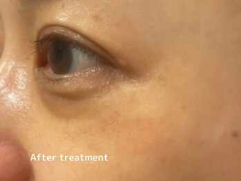 オアシスラグーン(OASIS LAGOON)/しわケア(症例3:after)