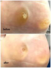 ラヴィ(La vie)/魚の目の悩み