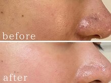 フォー(For...)/肌質改善/ニキビケア◇天王寺