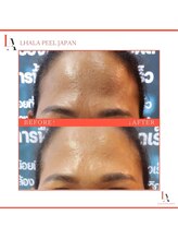 エナ(ENAK)/ララピール　（6回施術）