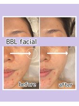 グラント(grant)/【BBL】ビフォーアフター