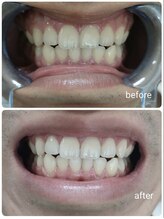 エクシアホワイト 新宿御苑店(ecxia white)/ホワイトニングビフォーアフター