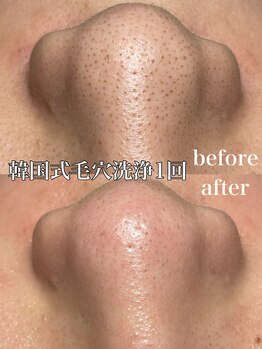 ビエン(bien)/韓国式3D毛穴洗浄