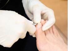 厚木 海老名 巻き爪矯正センター/◇丁寧に爪切りも行います◇