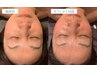 【リピート率90%超!!】美肌と小顔に導く！ガリレオピーリング＋小顔／40分