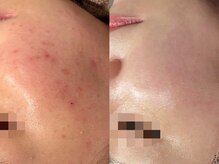 ルース 白河店(LUZ)/ニキビ症例写真