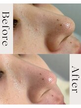 ピース(PEACE)/毛穴洗浄＆吸引