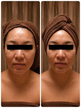 プティ ニド(Petit Nid)の写真/【1度で変化！本気の小顔ケア】むくみ・滞りを改善→パーツをあるべき所へ戻せばこんなに見違える印象に☆