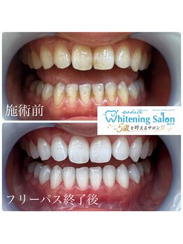 ホワイトニングサロン 四日市whiteの写真/短期集中で理想の白さへ♪フリーパスで集中的にホワイトニング！