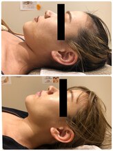 エイシスグロウ(asis glow.)/効果写真