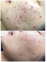 アンジェロ/【ニキビケア】肌育プログラム